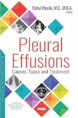 Pleural Effusions - 