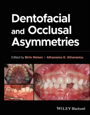 Dentofacial and Occlusal Asymmetries -  Melsen