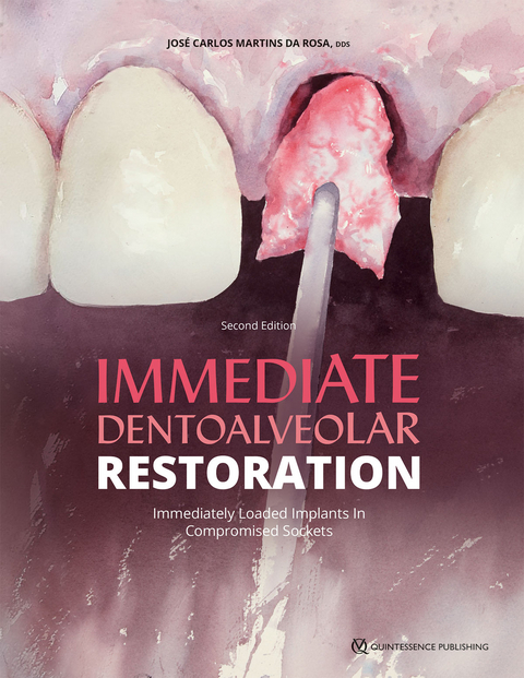 Immediate Dentoalveolar Restoration - José Carlos Martins da Rosa