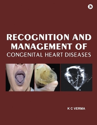 Recognition and Management of Congenital Heart Diseases -  K C Verma