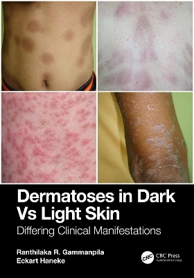 Dermatoses in Dark Vs Light Skin - Ranthilaka R. Gammanpila, Eckart Haneke