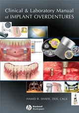 Clinical and Laboratory Manual of Implant Overdentures -  Hamid R. Shafie