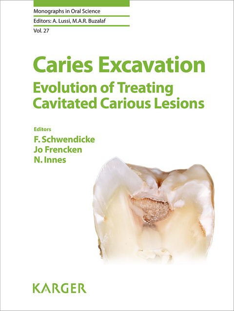 Caries Excavation: Evolution of Treating Cavitated Carious Lesions - 