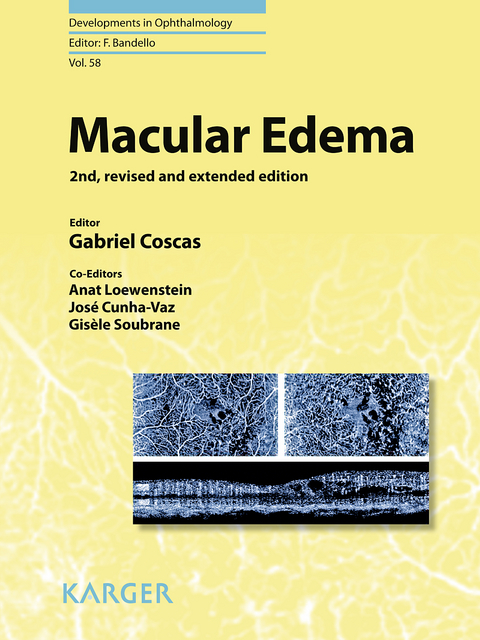 Macular Edema - 