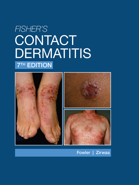 Fisher's Contact Dermatitis - 7th Edition -  Joseph F. Fowler,  Matthew J. Zirwas