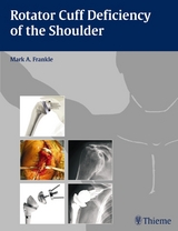 Rotator Cuff Deficiency of the Shoulder - 