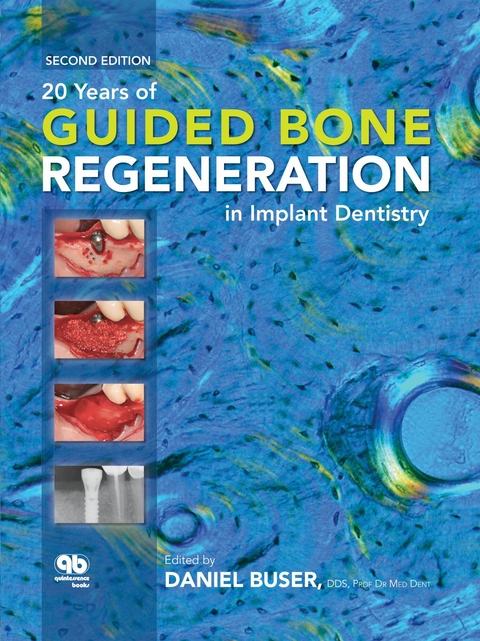 20 Years of Guided Bone Regeneration in Implant Dentistry - Daniel Buser