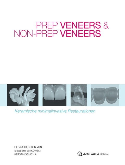 Prep Veneers und Non-Prep Veneers - Siegbert Witkowski, Kerstin Schicha