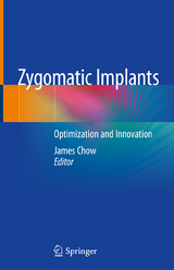 Zygomatic Implants - 