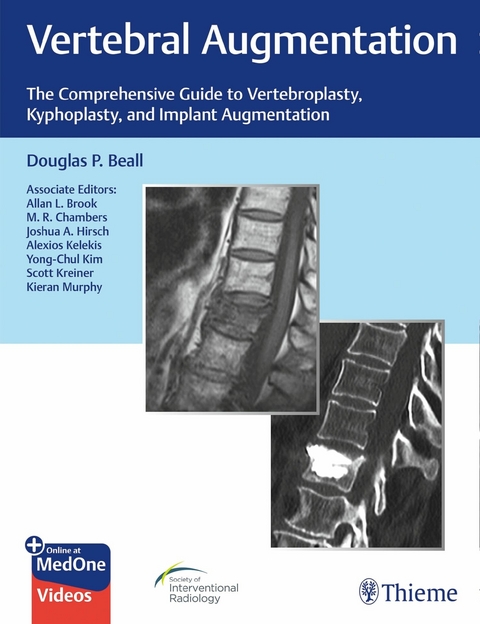 Vertebral Augmentation - Douglas P. Beall