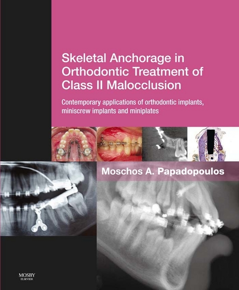 Skeletal Anchorage in Orthodontic Treatment of Class II Malocclusion E-Book - 