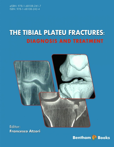 Tibial Plateau Fractures: Diagnosis and Treatment - 