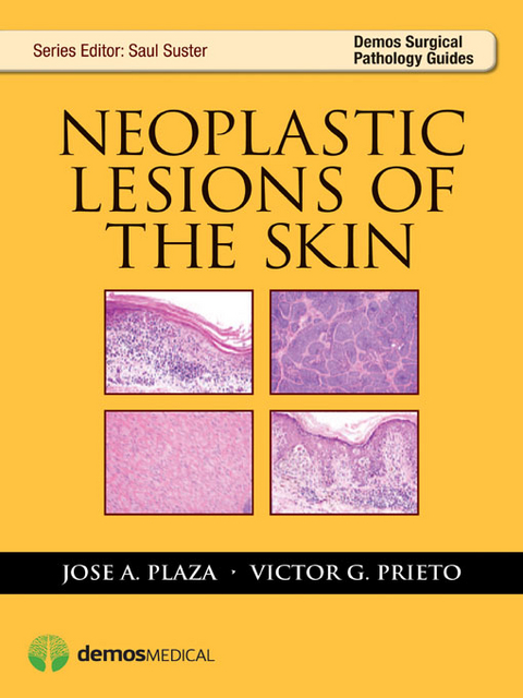 Neoplastic Lesions of the Skin -  MD Jose A. Plaza, PhD Victor G. Prieto MD