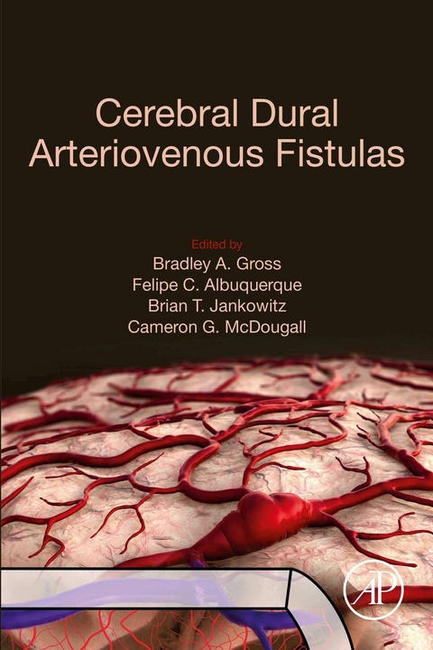 Cerebral Dural Arteriovenous Fistulas - 