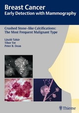 Breast Cancer: Early Detection with Mammography - Laszlo Tabar, Tibor Tot, Peter B. Dean