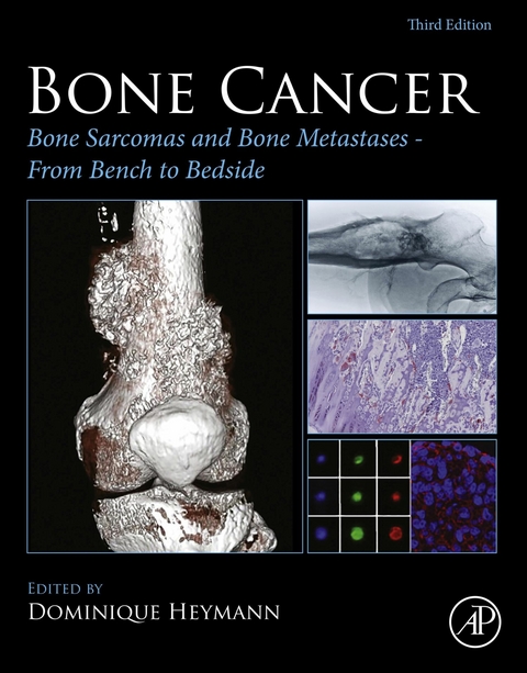 Bone Cancer - 