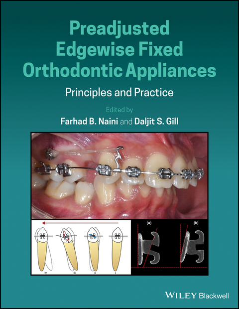 Preadjusted Edgewise Fixed Orthodontic Appliances - 