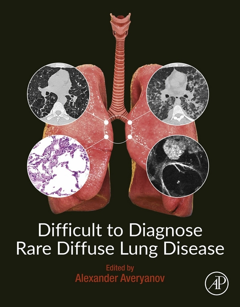 Difficult to Diagnose Rare Diffuse Lung Disease - 