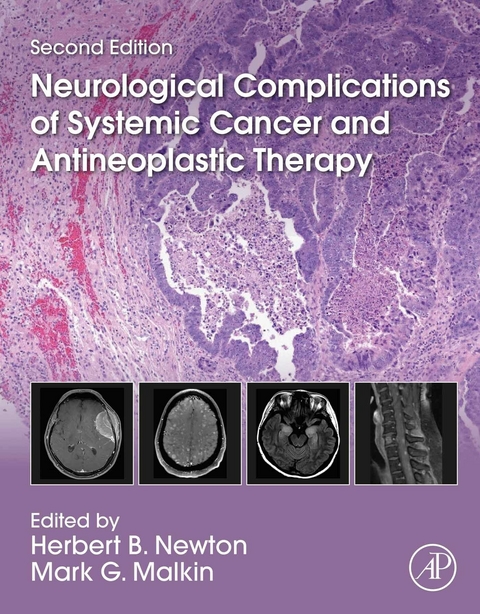 Neurological Complications of Systemic Cancer and Antineoplastic Therapy - 