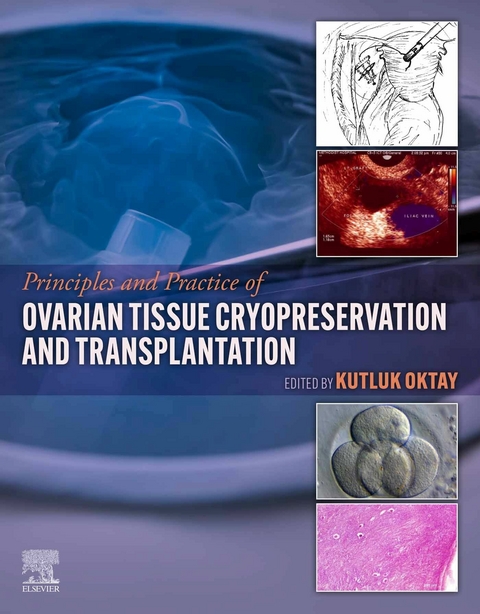 Principles and Practice of Ovarian Tissue Cryopreservation and Transplantation - 