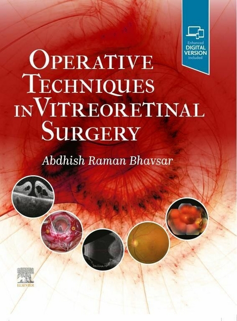 Operative Techniques in Vitreoretinal Surgery E-Book - 