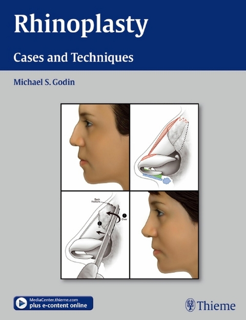 Rhinoplasty -  Michael S. Godin