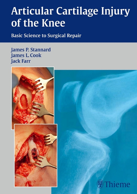 Articular Cartilage Injury of the Knee: Basic Science to Surgical Repair - 