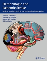 Hemorrhagic and Ischemic Stroke - 