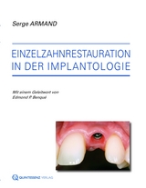 Einzelzahnrestauration in der Implantologie - Serge Armand