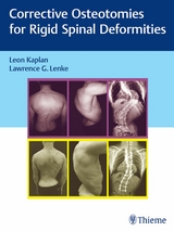 Corrective Osteotomies for Rigid Spinal Deformities - 