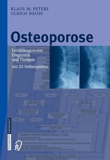 Osteoporose - Klaus M. Peters, Ulrich Deuß