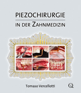Piezochirurgie in der Zahnmedizin - Tomaso Vercellotti