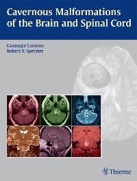 Cavernous Malformations of the Brain and Spinal Cord - 