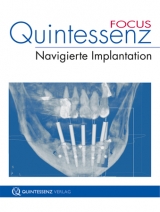 Quintessenz FOCUS Navigierte Implantation - 