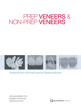 Prep Veneers und Non-Prep Veneers - 