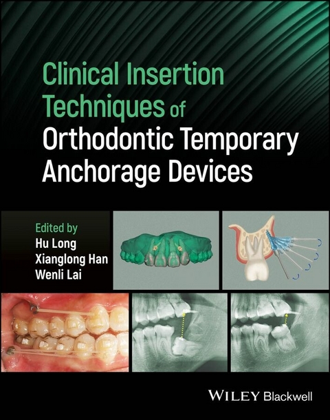Clinical Insertion Techniques of Orthodontic Temporary Anchorage Devices - 