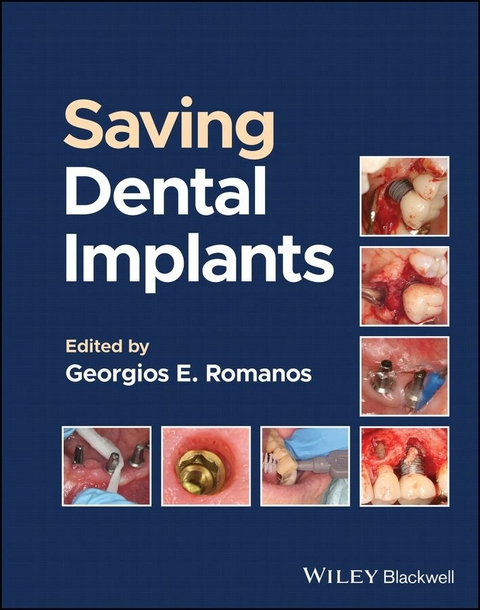 Saving Dental Implants - 