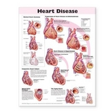 Heart Disease Anatomical Chart - 