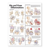 Hip and Knee Inflammations Anatomical Chart - 