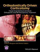 Orthodontically Driven Corticotomy - 