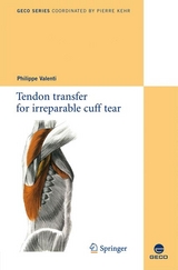 Tendon transfer for irreparable cuff tear - 