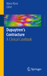 Dupuytren’s Contracture - 