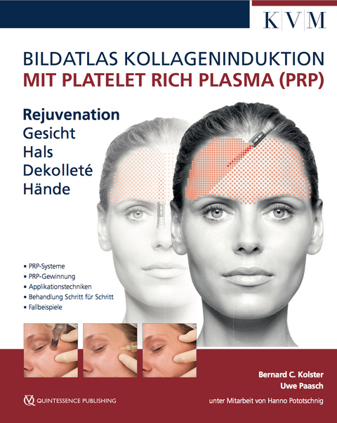 Bildatlas Kollageninduktion mit Platelet Rich Plasma (PRP) - Uwe Paasch, Bernard Kolster