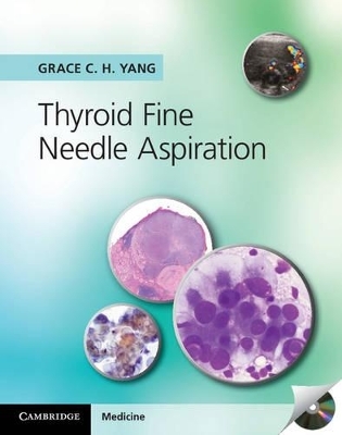 Thyroid Fine Needle Aspiration with CD Extra - Grace C. H. Yang