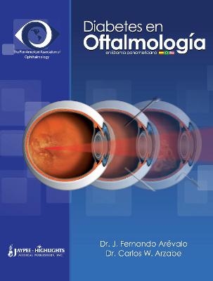 Diabetes en Oftalmología - J Fernando Arevalo, Carlos W Arzabe