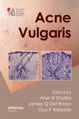 Acne Vulgaris - 