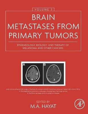 Brain Metastases from Primary Tumors, Volume 3 - 