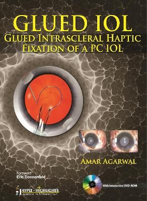 GLUED IOL - Amar Agarwal