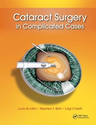 Cataract Surgery in Complicated Cases - Lucio Buratto, Stephen Brint, Luigi Caretti