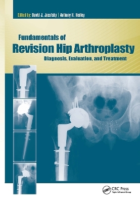 Fundamentals of Revision Hip Arthroplasty - David Jacofsky, Anthony Hedley